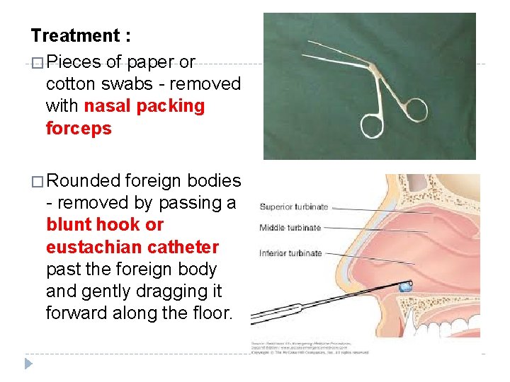 Treatment : � Pieces of paper or cotton swabs - removed with nasal packing