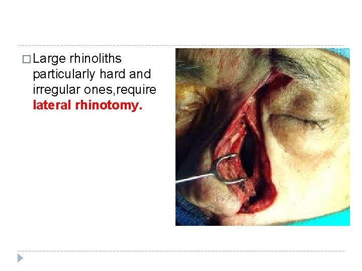 � Large rhinoliths particularly hard and irregular ones, require lateral rhinotomy. � Large rhinoliths particularly hard and irregular ones, require lateral rhinotomy.
