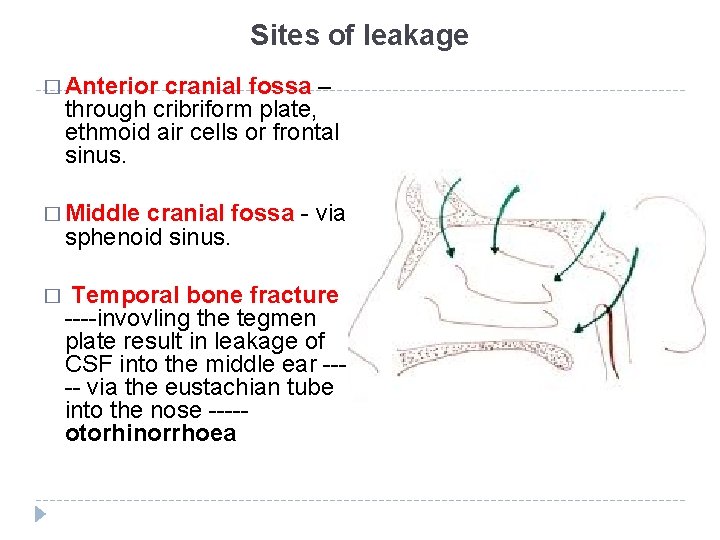 Sites of leakage � Anterior cranial fossa – through cribriform plate, ethmoid air cells