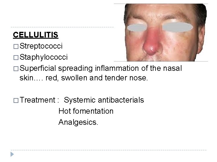 CELLULITIS � Streptococci � Staphylococci � Superficial spreading inflammation of the nasal skin…. red,
