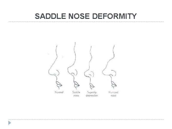 SADDLE NOSE DEFORMITY SADDLE NOSE DEFORMITY