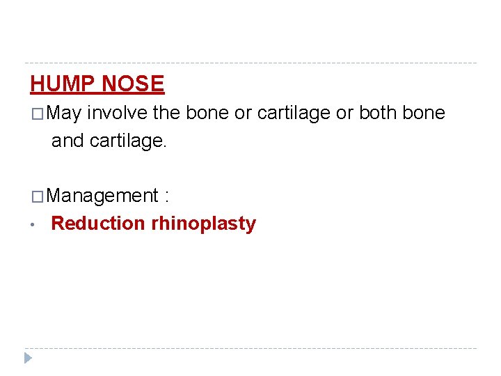 HUMP NOSE �May involve the bone or cartilage or both bone and cartilage. �Management