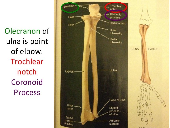 Olecranon of ulna is point of elbow. Trochlear notch Coronoid Process 