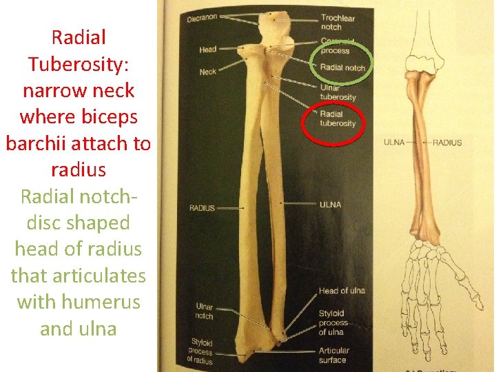 Radial Tuberosity: narrow neck where biceps barchii attach to radius Radial notchdisc shaped head Radial Tuberosity: narrow neck where biceps barchii attach to radius Radial notchdisc shaped head