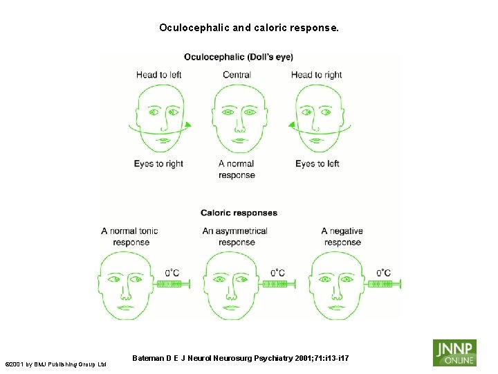 Oculocephalic and caloric response. © 2001 by BMJ Publishing Group Ltd Bateman D E