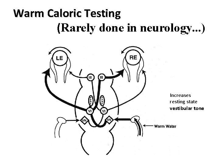 Warm Caloric Testing (Rarely done in neurology. . . ) Increases resting state vestibular