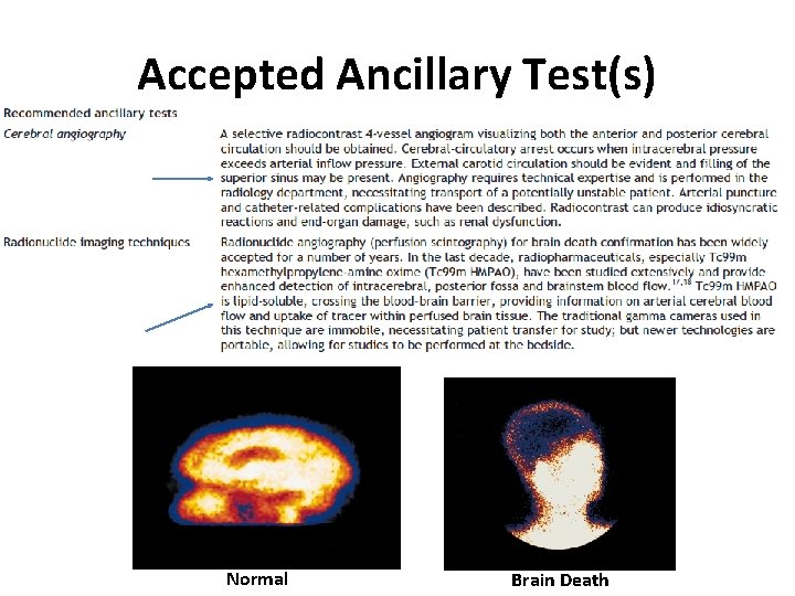 Accepted Ancillary Test(s) Normal Brain Death 