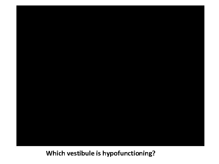 Which vestibule is hypofunctioning? 