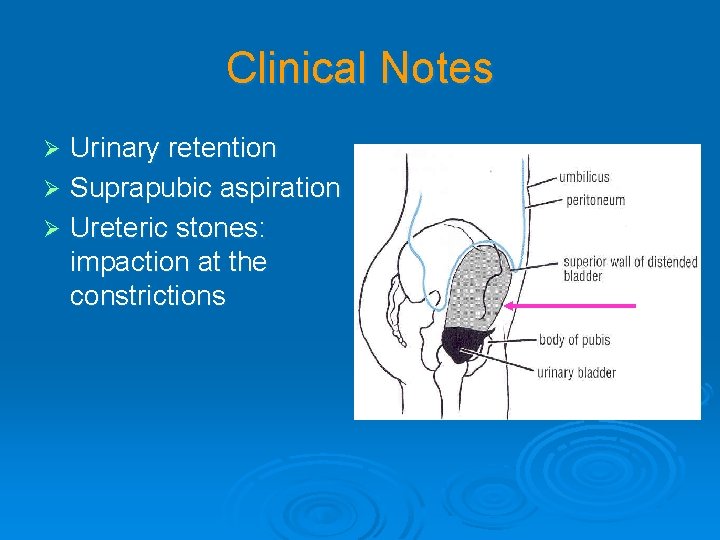 Clinical Notes Urinary retention Ø Suprapubic aspiration Ø Ureteric stones: impaction at the constrictions
