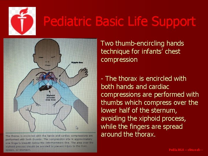 Pediatric Basic Life Support Two thumb-encircling hands technique for infants’ chest compression - The Pediatric Basic Life Support Two thumb-encircling hands technique for infants’ chest compression - The