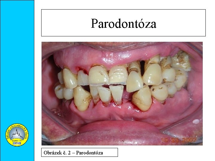 Parodontóza Obrázek č. 2 – Parodontóza 