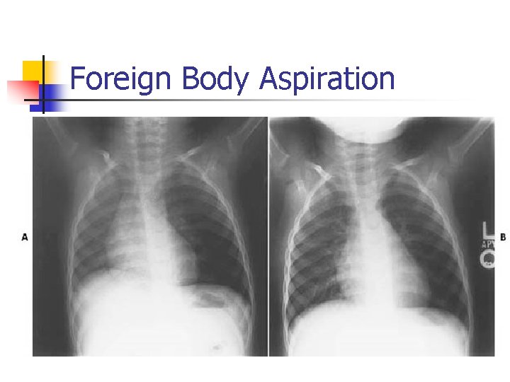 Foreign Body Aspiration 