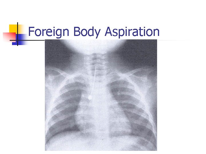 Foreign Body Aspiration 