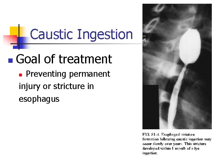 Caustic Ingestion n Goal of treatment Preventing permanent injury or stricture in esophagus n