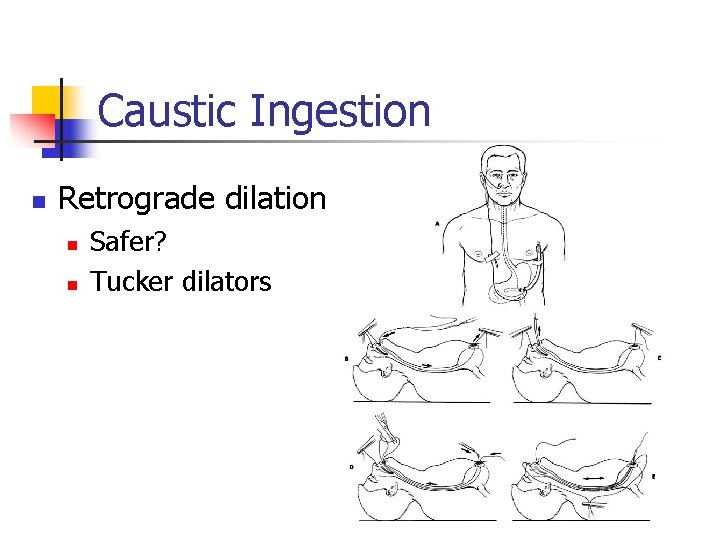 Caustic Ingestion n Retrograde dilation n n Safer? Tucker dilators 