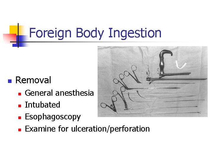 Foreign Body Ingestion n Removal n n General anesthesia Intubated Esophagoscopy Examine for ulceration/perforation