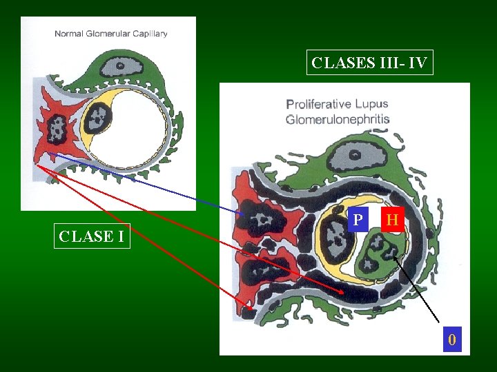 CLASES III- IV CLASE I P H 0 