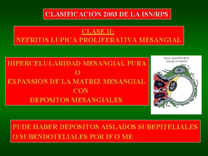 CLASIFICACIÓN 2003 DE LA ISN/RPS CLASE II: NEFRITIS LÚPICA PROLIFERATIVA MESANGIAL HIPERCELULARIDAD MESANGIAL PURA