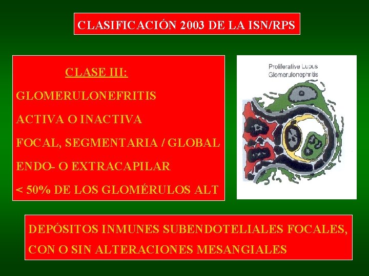 CLASIFICACIÓN 2003 DE LA ISN/RPS CLASE III: GLOMERULONEFRITIS ACTIVA O INACTIVA FOCAL, SEGMENTARIA /