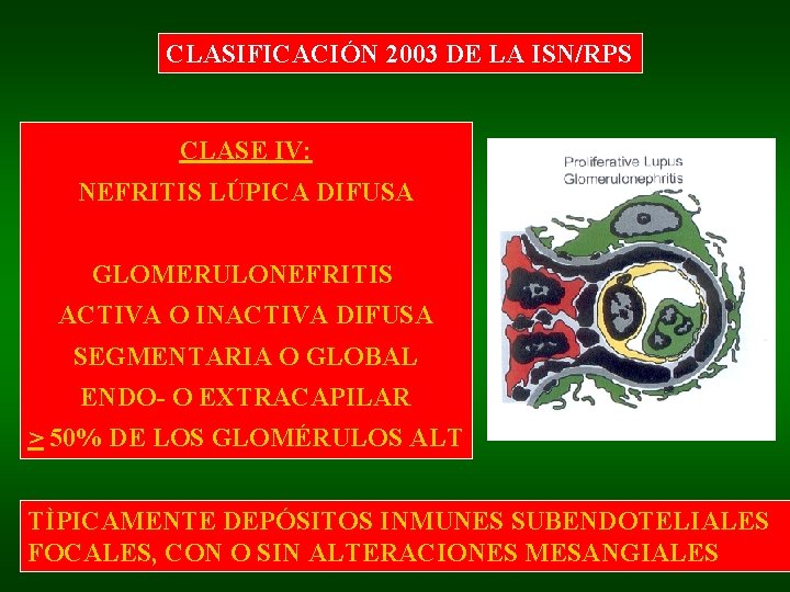 CLASIFICACIÓN 2003 DE LA ISN/RPS CLASE IV: NEFRITIS LÚPICA DIFUSA GLOMERULONEFRITIS ACTIVA O INACTIVA