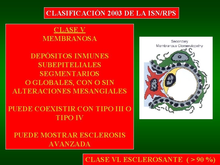 CLASIFICACIÓN 2003 DE LA ISN/RPS CLASE V MEMBRANOSA DEPÓSITOS INMUNES SUBEPITELIALES SEGMENTARIOS O GLOBALES,