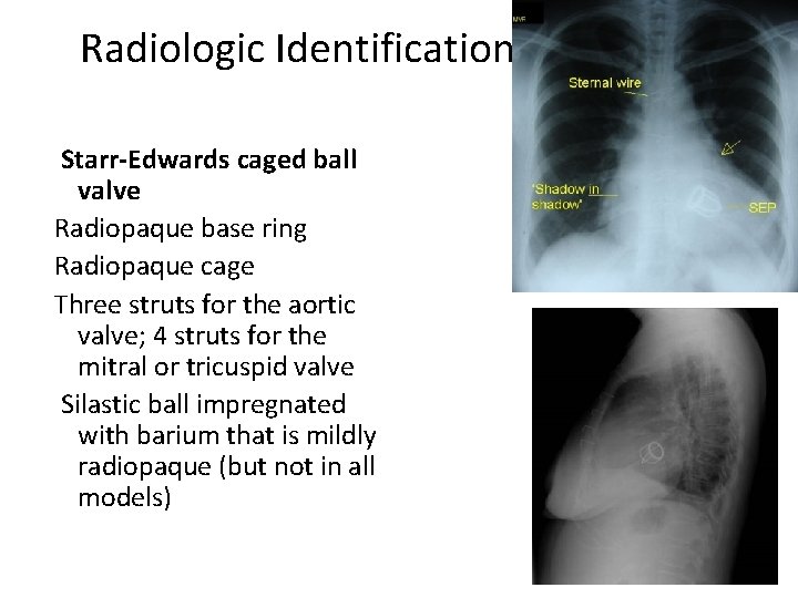 Radiologic Identification Starr-Edwards caged ball valve Radiopaque base ring Radiopaque cage Three struts for