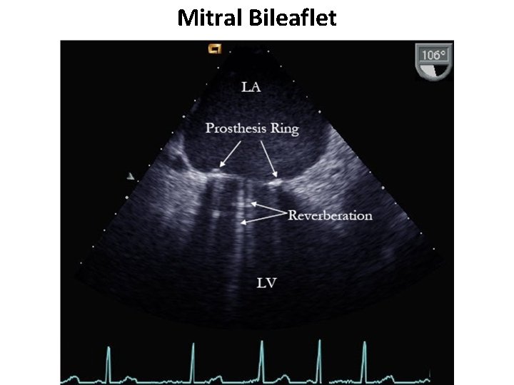 Mitral Bileaflet 