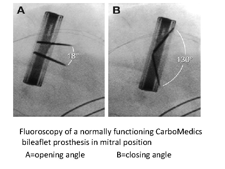 Fluoroscopy of a normally functioning Carbo. Medics bileaflet prosthesis in mitral position A=opening angle