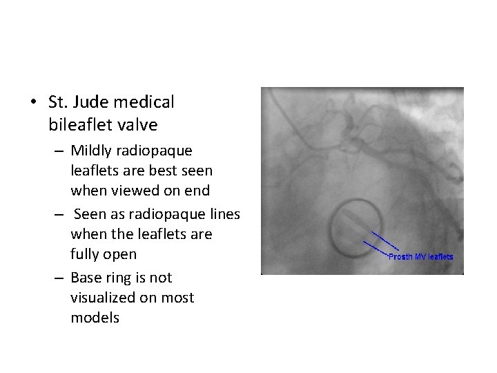  • St. Jude medical bileaflet valve – Mildly radiopaque leaflets are best seen