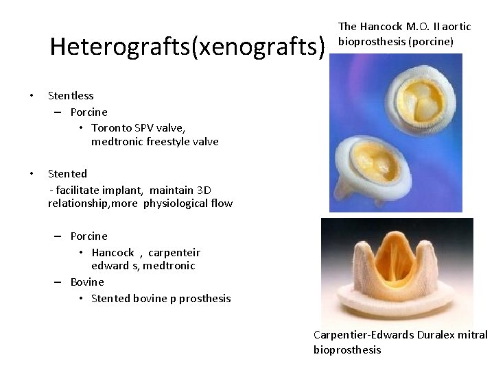 Heterografts(xenografts) • Stentless – Porcine • Toronto SPV valve, medtronic freestyle valve • Stented