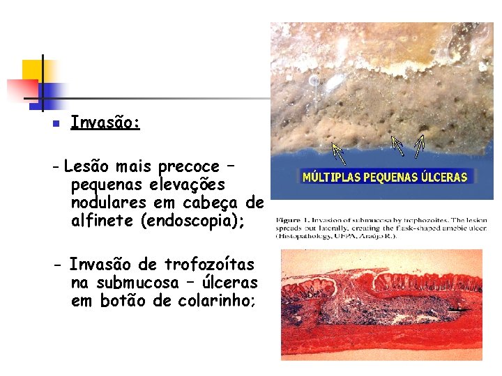 n Invasão: - Lesão mais precoce – pequenas elevações nodulares em cabeça de alfinete