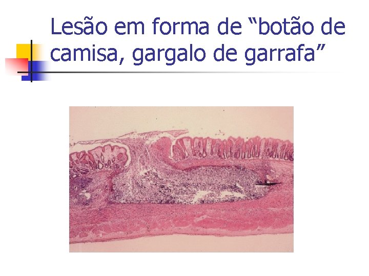 Lesão em forma de “botão de camisa, gargalo de garrafa” 