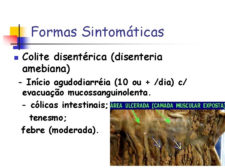 Formas Sintomáticas n Colite disentérica (disenteria amebiana) - Início agudodiarréia (10 ou + /dia)