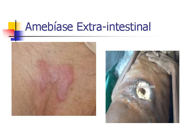 Amebíase Extra-intestinal 