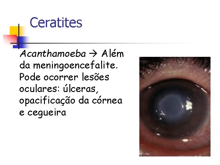 Ceratites Acanthamoeba Além da meningoencefalite. Pode ocorrer lesões oculares: úlceras, opacificação da córnea e