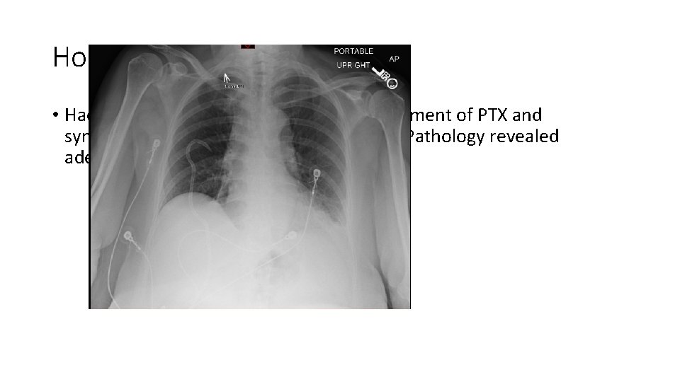 Hospital course • Had pigtail chest tube placed with improvement of PTX and symptoms.