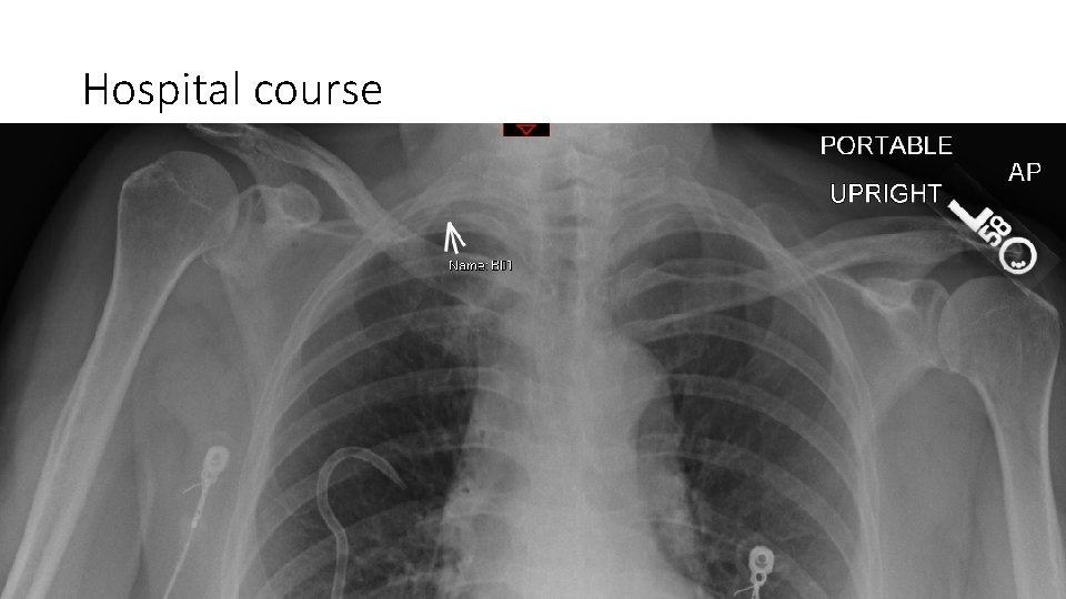 Hospital course • Had pigtail chest tube placed with improvement of PTX and symptoms.