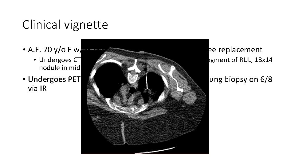Clinical vignette • A. F. 70 y/o F w/ tachycardia 23 days after R