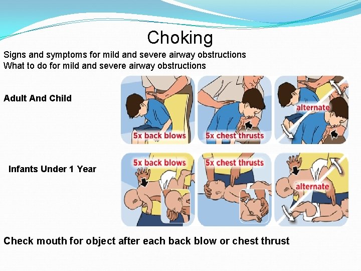 Choking Signs and symptoms for mild and severe airway obstructions What to do for