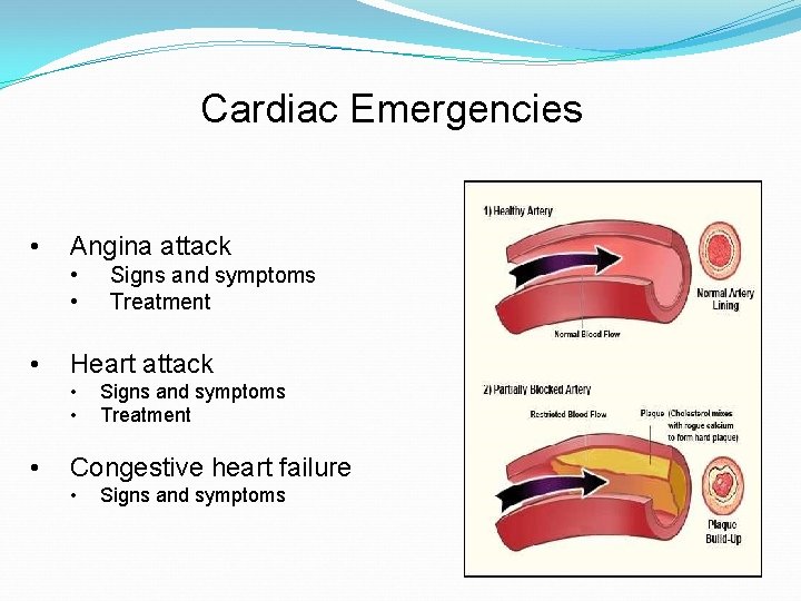 Cardiac Emergencies • Angina attack • • • Heart attack • • • Signs