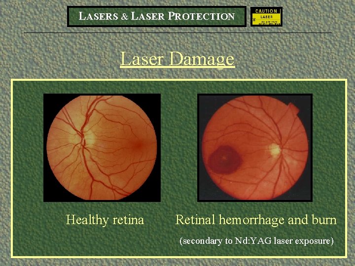 LASERS & LASER PROTECTION Laser Damage Healthy retina Retinal hemorrhage and burn (secondary to