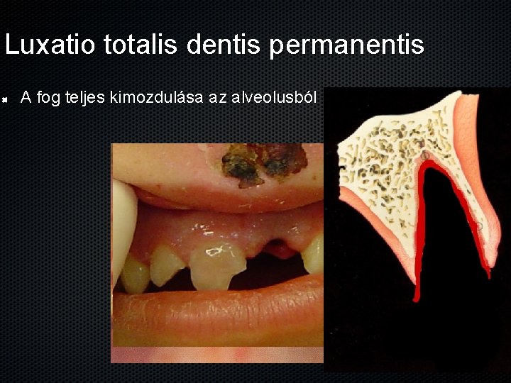 Luxatio totalis dentis permanentis A fog teljes kimozdulása az alveolusból 