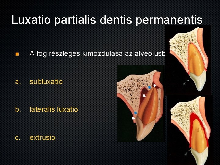 Luxatio partialis dentis permanentis n A fog részleges kimozdulása az alveolusból a. subluxatio b.
