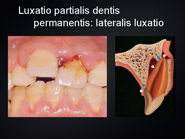 Luxatio partialis dentis permanentis: lateralis luxatio 