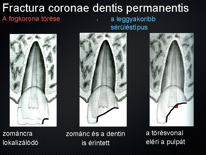 Fractura coronae dentis permanentis A fogkorona törése zománcra lokalizálódó • a leggyakoribb sérüléstípus zománc