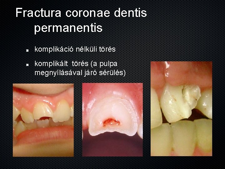 Fractura coronae dentis permanentis komplikáció nélküli törés komplikált törés (a pulpa megnyílásával járó sérülés)