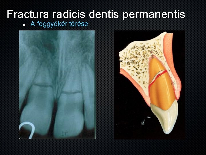 Fractura radicis dentis permanentis A foggyökér törése 