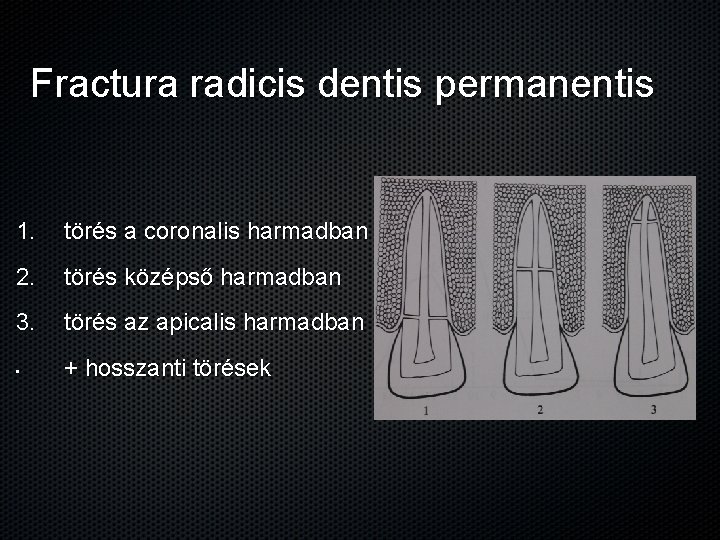 Fractura radicis dentis permanentis 1. törés a coronalis harmadban 2. törés középső harmadban 3.