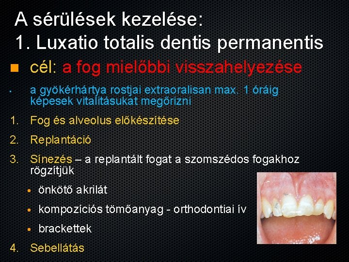 A sérülések kezelése: 1. Luxatio totalis dentis permanentis n • cél: a fog mielőbbi