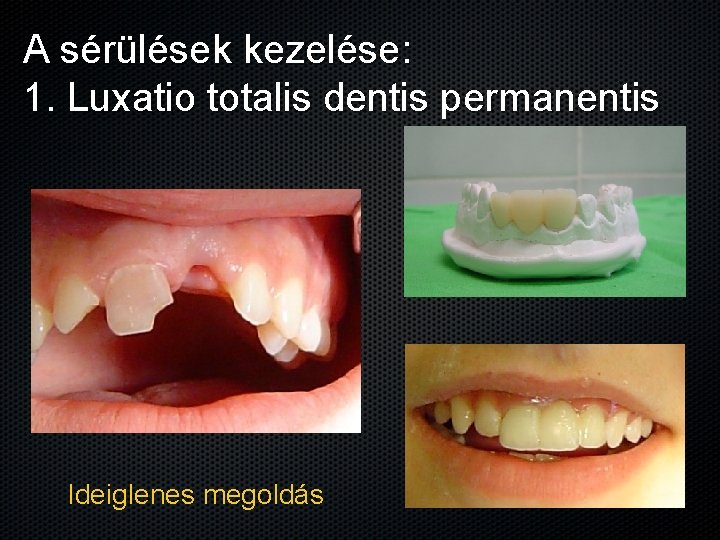 A sérülések kezelése: 1. Luxatio totalis dentis permanentis Ideiglenes megoldás 